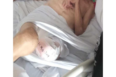 Esta es una imagen de Gildardo Aguirre Suárez, de 91 años, facilitada por sus familiares. La foto se tomó tras la amputación de su miembro inferior izquierdo.