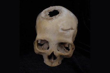 Imagen de un cráneo datado entre el 663 y el 343 a.C., y perteneciente a una mujer de más de 50 años. En la parte izquierda del cráneo se aprecia el fuerte traumatismo al que sobrevivió años antes de morir, y arriba a la derecha, el agujero causado por la neoplasia. 
